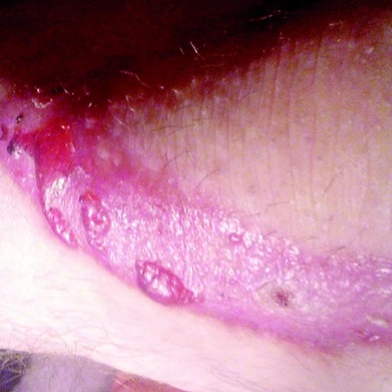 Cicatrisation. La peau est tellement fine que plier les genoux la déchire. Photo : DR